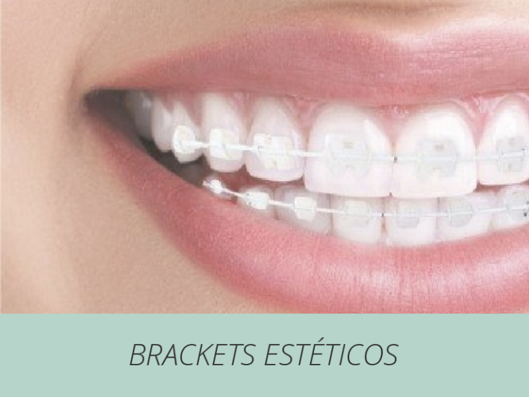 bracket invisibles