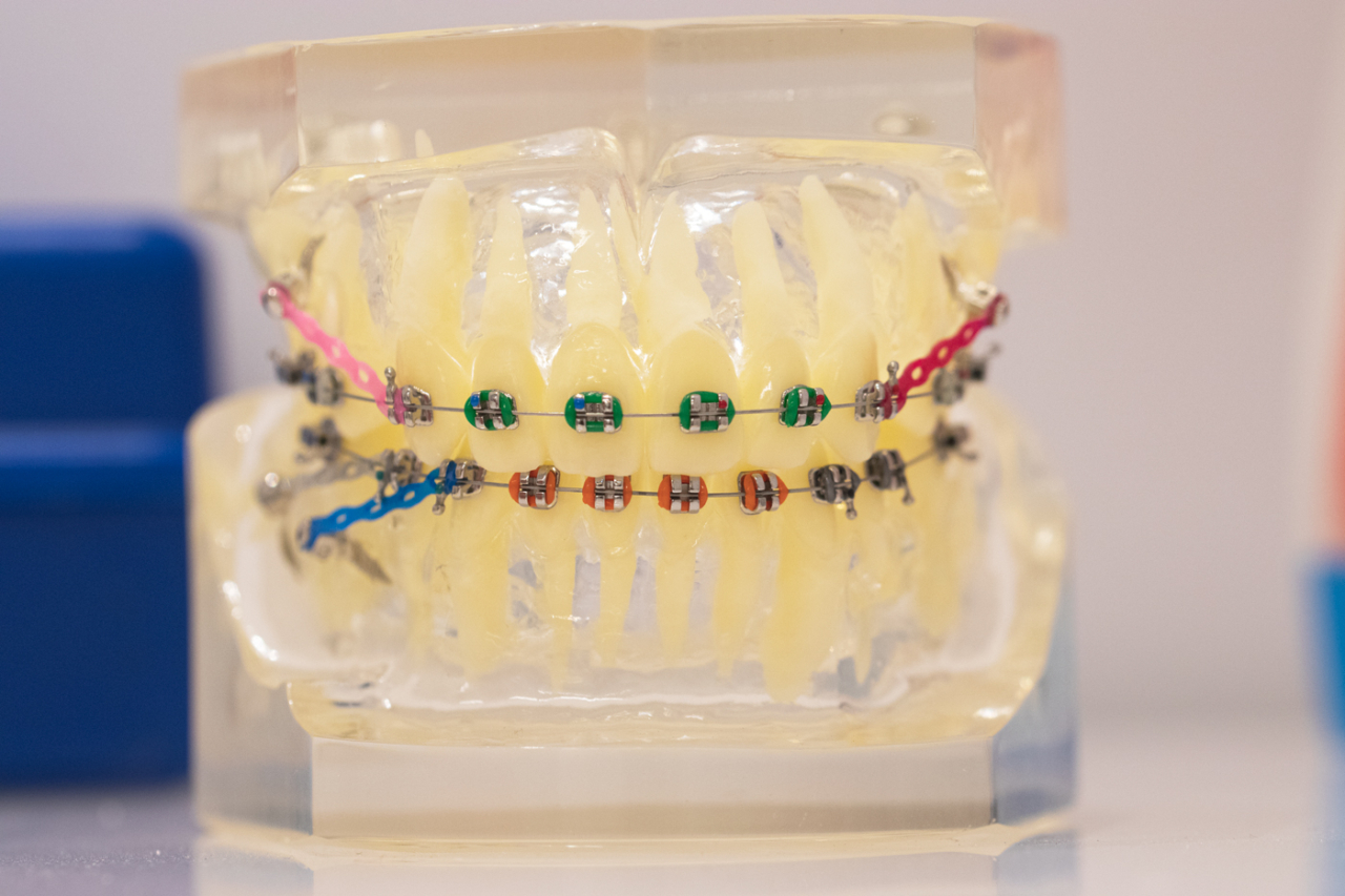 ¿Para qué sirven las gomas de los brackets? - Clínica Garden