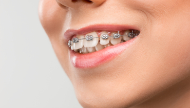 ¿Cuál es la edad límite para la ortodoncia?